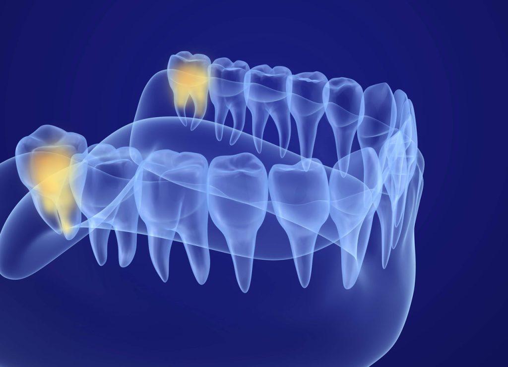 Il Dente Del Giudizio Dall Eruzione All Estrazione Centro Biomedica